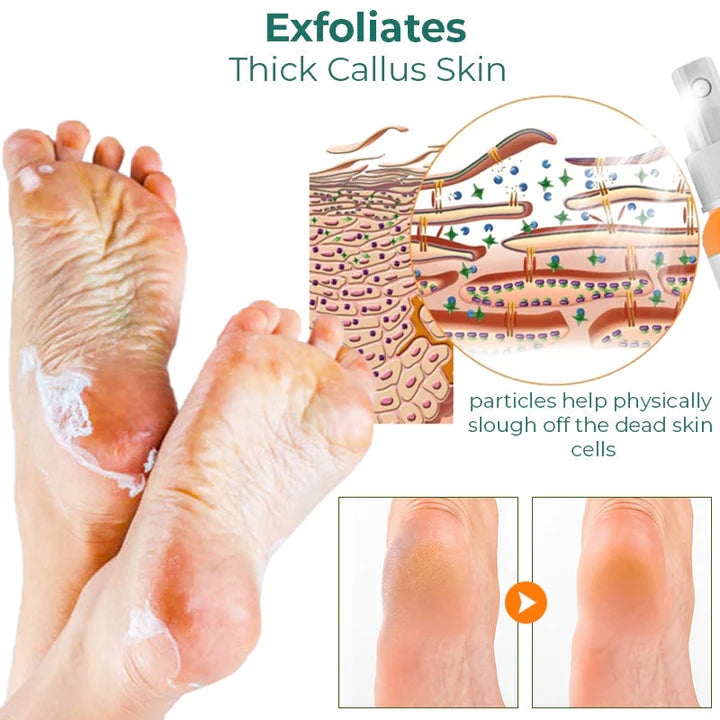 Foot Callus Removal Spray